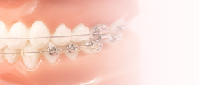 矯正歯科 Orthodontic