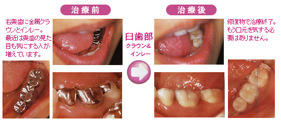 セラミックの場合（臼歯部　詰め物・被せ物）